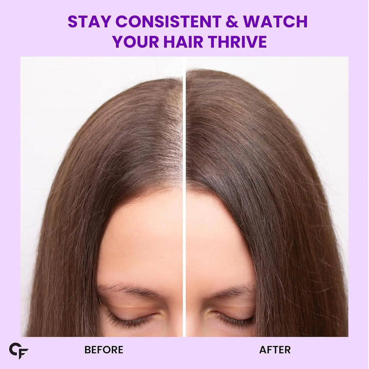 Carbamide Forte Biotin Tablets for Hair Growth with Amla, Brahmi & Bamboo Extract | Hair Growth Tablet | 90 Veg Tablet - Halt